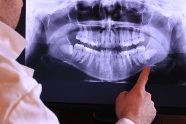 Best Emergency Root Canal Treatment in Louisvle, IL